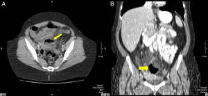 48-Year-old woman with perforated acute appendicitis: (A) MDCT demonstrating an abscess (arrow) and free liquid in the pelvis, without identification of the appendix; (B) coronal reconstruction of the same patient with a collection of gas (arrow) in the pelvis. Anatomic pathology confirmed perforated appendicitis.