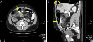 44-Year-old male with pneumoperitoneum: (A) MDCT axial slice with oral and IV contrast showing extraluminal gas and extravasation of oral contrast (bold arrow), intense adjacent fat stranding (*), and thickening of the small bowel loops (thin arrow); (B) sagittal reconstruction showing the extravasation of oral contrast (arrow) and fat stranding (*); an SOL in the liver is also observed (curved arrow). Surgery confirmed perforation of the small intestine, while pathology confirmed the presence of a large-cell carcinoma in the distal ileum with infiltration in the mesentery and hepatic metastasis.