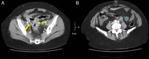 54-Year-old woman with acute abdominal symptoms and pneumoperitoneum seen on MDCT: (A) MDCT axial slice with IV contrast of the pelvis revealing asymmetrical thickening of the sigma wall (thin arrow), free fluid, and an adjacent abscess with air-fluid level (bold arrow); (B) axial slice at a more cranial level where a pathologic retroperitoneal lymphadenopathy is observed (17mm). The pathology study confirmed a perforated adenocarcinoma of the sigma with positive retroperitoneal lymph nodes.