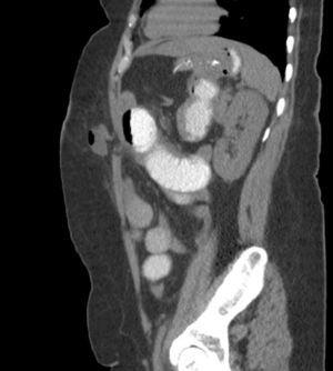 Radiologic diagnosis of an unsuspected and asymptomatic incisional hernia four months after laparoscopic bariatric surgery.