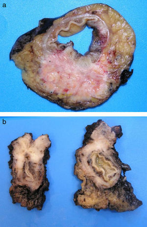 Sequential cross-sections of intramural ADC evolved from the anal glands: (A) from the middle third of the anal canal, close to the radial margin; and (B) from the distal part of the anal canal with infiltration of the perianal musculature.