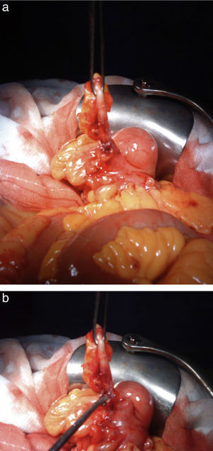 (a and b) Inflammatory mass in the right iliac fossa (RIF) encompassing the appendix with an orifice that corresponds with the appendix-graft fistula.