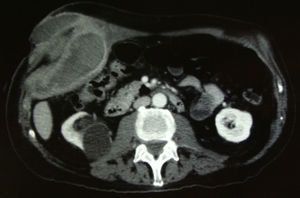 Abdominal computed tomography, cross-sectional slice.