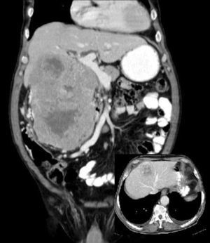 Abdominal CT: retroperitoneal mass and hepatic M1 in segment iv.