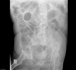 Initial image of intestinal obstruction due to adhesions.