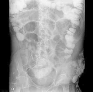 Intestinal obstruction after the administration of Gastrografin® with resolution of symptoms.