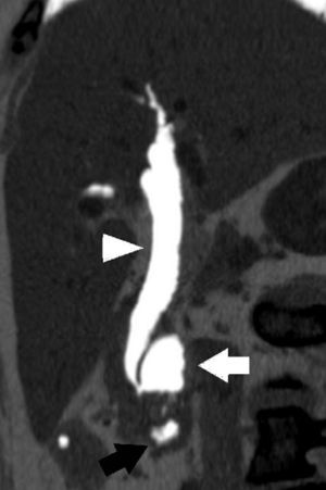 Multidetector computed tomography; oblique multiplanar reconstruction at minimum intensity projection showing air in the common bile duct (white arrowhead), juxtapapillary duodenal diverticulum (white arrow) and horizontal portion of the duodenum (black arrow).