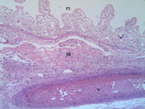 Microphotography showing histologic detail of the mucosal necrosis (m) with total loss of the epithelium, fibrinoid deposits (fd) in the submucosa and thrombotic venule (v) (hematoxylin–eosin 100×).