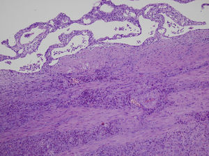 Gallbladder wall with intense fibrosis and inflammatory infiltrate (H–E, 10×).