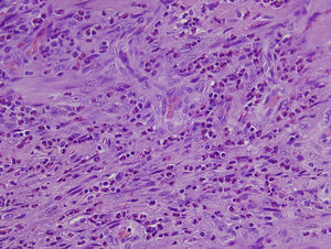 Detail of the inflammatory infiltrate with numerous eosinophils (H–E, 40×).