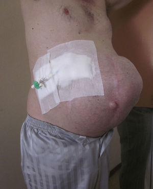 Patient with a large incisional hernia and loss of domain, before the intervention.