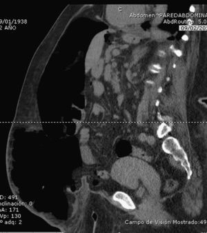 After the pneumoperitoneum, sagittal tomography demonstrates that the viscera almost completely fit into the abdominal cavity.