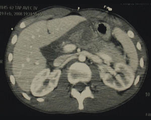 Abdominal-pelvic CT: pancreatic hypodensity, enlarged body of the pancreas with infiltration of fat. These findings are suspicious for a complete section of the pancreas.