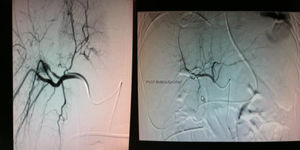 Pseudoaneurysm filled by branches of the right hepatic artery (arteries of segments VII and VIII). Endovascular coil embolization was performed. Right image: arteriography where no evidence of contrast leak is observed after embolization.