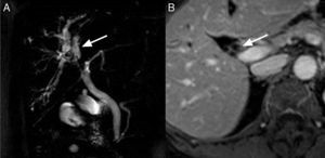 (A) Magnetic resonance cholangiography image showing dilatation of the right intrahepatic bile duct, with no observed cause of the obstruction; (B) magnetic resonance image demonstrating thickening of the bile duct wall.