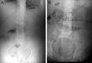 (A) Abdominal radiograph showing gallstone in the right upper quadrant. (B) Abdominal radiograph showing gallstone in the right lower quadrant in the same patient, one year later, in the ER with biliary ileus symptoms (note the change in position of the calculus).