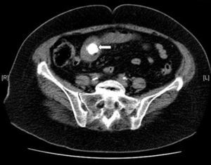 Axial CT cut showing the presence of an impacted calculus in the small intestine.