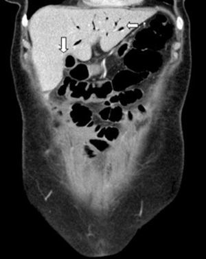 Coronal CT reconstruction showing a cholecysto-duodenal fistula and pneumobilia.