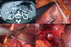 (A) Abdominal CT scan with contrast. The arrow indicates the tumor in the tail of the pancreas infiltrating the splenic vein; (B) dissection of the transverse mesocolon. The arrow indicates the inferior mesenteric vein; (C) placement of EndoGrab; (D) dissected tumor; the arrow indicates the splenic vein infiltrated by the tumor.