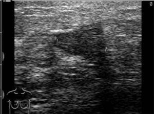 Poorly-defined hypoechoic lesion.