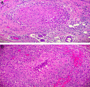(A) Non-caseating granuloma consisting of epithelioid histiocytes that are surrounded by lymphocytes and plasma cells (HE, 100×); (B) necrotizing granuloma: central necrosis surrounded by palisading epithelioid histiocytes, lymphocytes and plasma cells (HE, 100×).