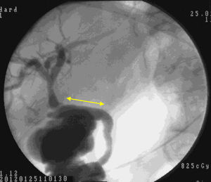Cholangiography 4 weeks after the interposition of the collagen-agarose bile duct prosthesis, with no presence of leakage or stenosis; the arrow indicates the position of the prosthesis.