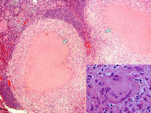 Anatomic pathology: lymph node with granulomas and areas of necrosis (arrows); view of a giant cell (hematoxylin–eosin stain, 40×).