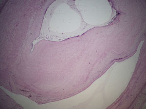 Large adventitial cyst protruding into the arterial lumen (hematoxylin–eosin stain, 2×).