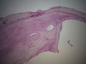 Small cysts of the arterial adventitia (hematoxylin–eosin stain, 2×).