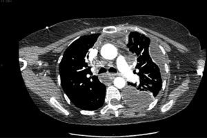 Thoracic CT of a patient with stage IIB DNM.