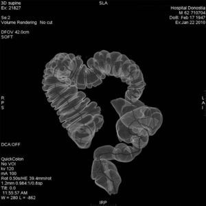 CT colonography: interposition of 2 small intestinal loops between the colon and rectum.