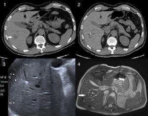 The CT scan shows a 2.5cm metastasis at the confluence of segments v-vi-vii-viii, which is resectable by non-anatomical hepatectomy. Marking with coils prior to neoadjuvant treatment (2) allows subsequent location of the metastasis with ultrasound although it is not ultrasonically visible (3). (4) The post chemotherapy MRI scan shows the metastasis which is 1cm in size.