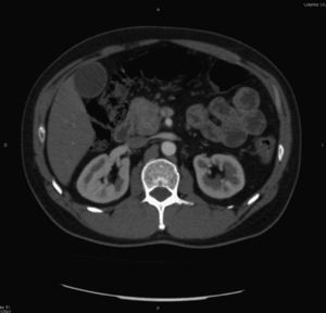 Pre-surgery abdominal-pelvic CT axial image. A tumourous lesion was identified located in the head of the pancreas although the porto-mesenteric infiltration which actually existed could not be confirmed.