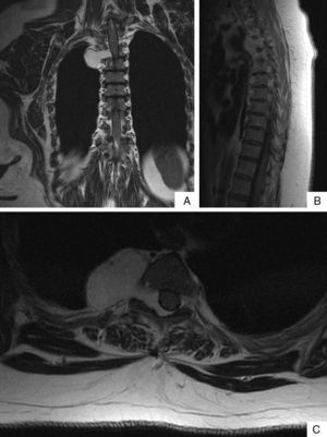 Magnetic resonance T2 showing a marked hyper-intensity of the mass invading the epidural space: (A) coronal section, (B) sagittal section and (C) transverse section.