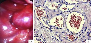 (A) Intra-operative findings show a well-defined, reddish mass in the posterior superior mediastinum. (B) Microscopic view showing vascular lakes with flattened endothelium. No atypias confirmed; 20× haematoxylin–eosin.