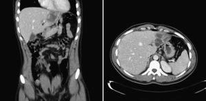 Cystic lesions with calcifications located in segments ii–iii.
