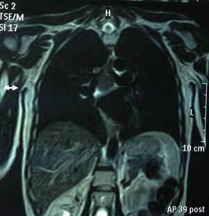 Chest MRI (sequence T1, coronal cut): subcarinal mediastinal mass of 45mm, hyperintense on T1.