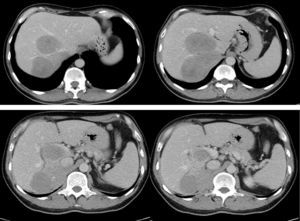 Preoperative computed tomography showing the large tumour invading the anatomic right lobe, segment I and the inferior vena cava (4 images), with only segments II–III remaining free (20% residual volume).