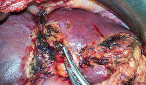 Intraoperative image of the second-stage intervention where the tourniquet groove to the right of the umbilical fissure is observed.