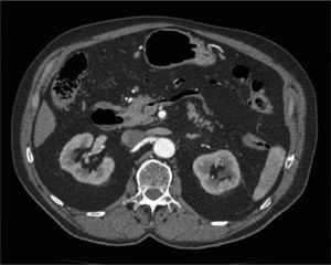 Abdominal-pelvic CT scan with intravenous contrast: extensive air level is observed at the splenic vein.