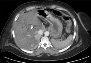 CT scan showing widespread hepatic hypoperfusion, several hemoclips and gas in the portal vein.