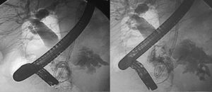 SDPD:ERCP:biliary tract dilatation and leak in pancreatic body.