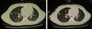 (A) Localization of the lesion with computed tomography; (B) CT-guided needle puncture.