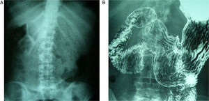 (A) Simple abdominal radiograph showing the stomach with important food retention; (B) upper GI study demonstrating the difficult emptying in the third part of the duodenum.