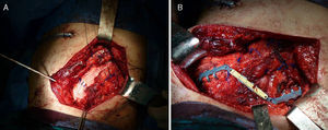 (A) Detail of the diaphragmatic resection supported by Gore-tex prosthesis. (B) STATOS connecting bar above themyoplasty.