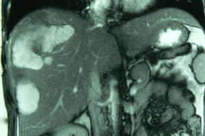 MRI: ruptured hepatic adenoma.