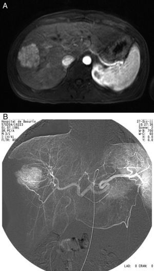 MRI and angiography prior to embolization.