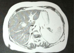 Abdominal MRI: an SOL is observed in segment VIII.