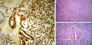 (a) Immunohistochemistry for estrogen receptors with positivity in the nuclei of the glands and stroma; (b) endometrial glands with endometrial stroma in the middle of a desmoplastic fibrous tissue (HE×100); (c) endometrial glands with endometrial stroma in the middle of a desmoplastic fibrous tissue at a greater magnification (HE×200).