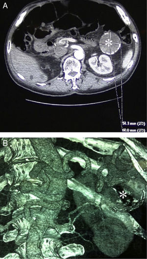 Preoperative computed tomography: (A) axial image, SAA 58mm×60mm and (B) three-dimensional reconstruction (*: SAA).